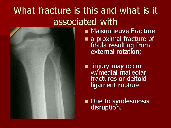 What fracture is this and what is it associated with n n Maisonneuve Fracture What fracture is this and what is it associated with n n Maisonneuve Fracture