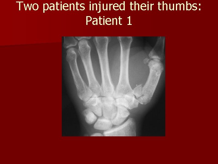 Two patients injured their thumbs: Patient 1 Two patients injured their thumbs: Patient 1