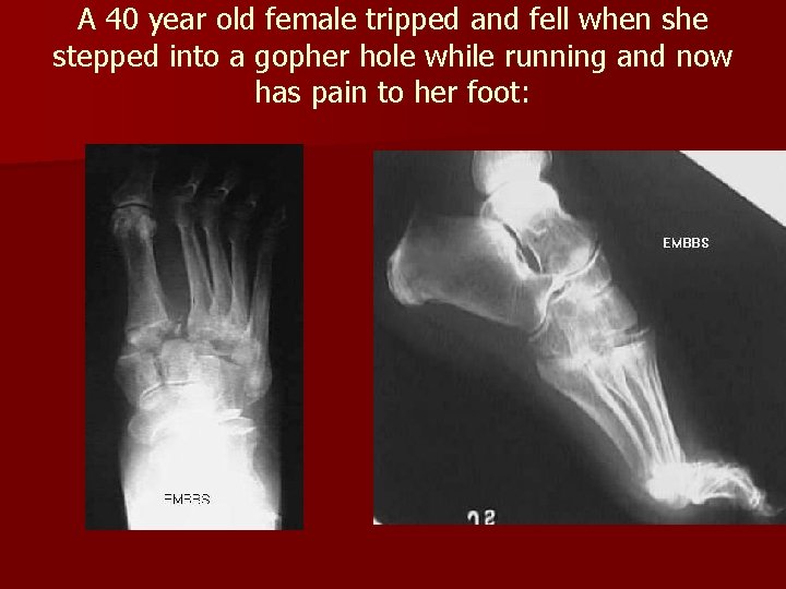 A 40 year old female tripped and fell when she stepped into a gopher A 40 year old female tripped and fell when she stepped into a gopher