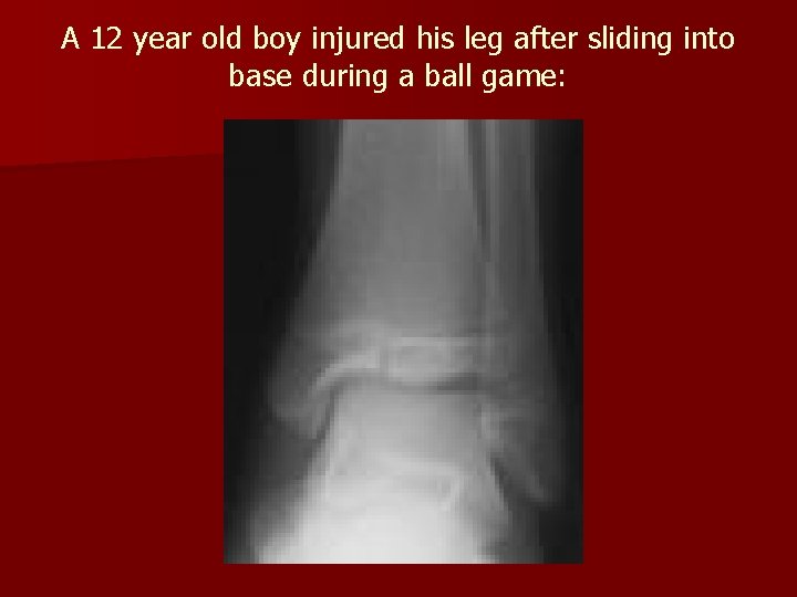 A 12 year old boy injured his leg after sliding into base during a A 12 year old boy injured his leg after sliding into base during a