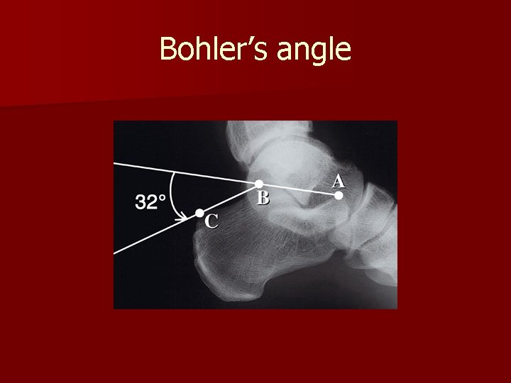 Bohler’s angle Bohler’s angle