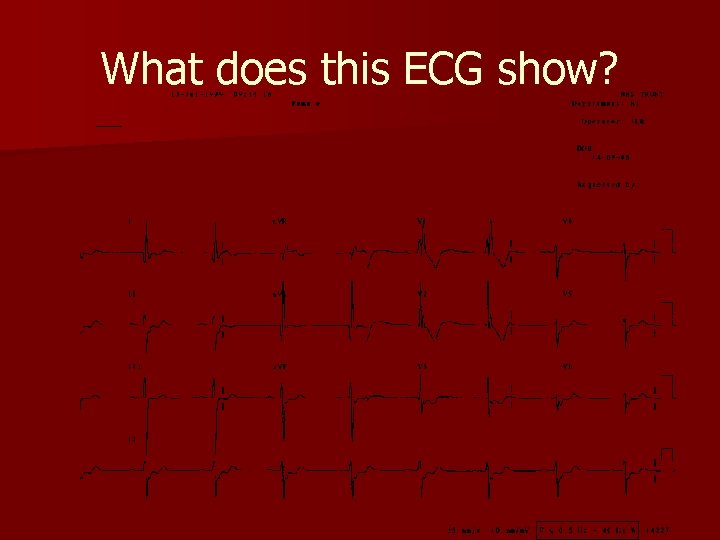 What does this ECG show? What does this ECG show?