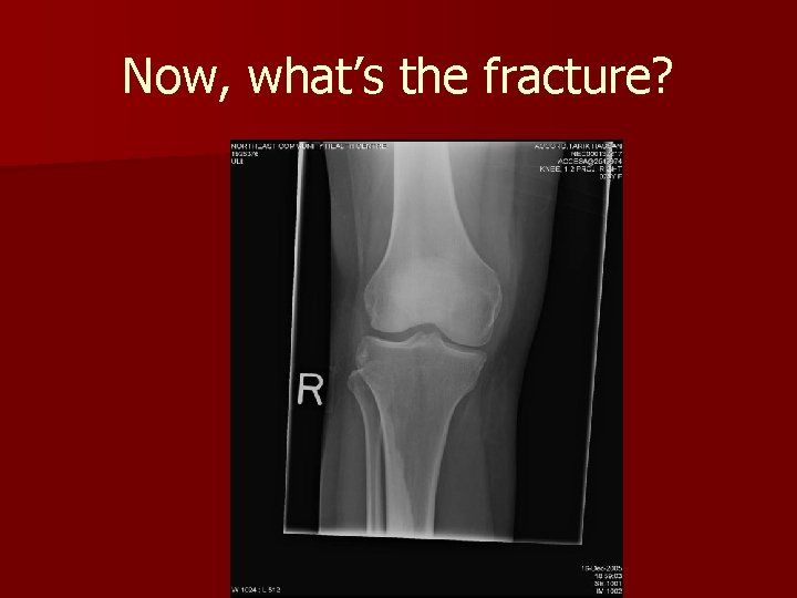 Now, what’s the fracture? Now, what’s the fracture?
