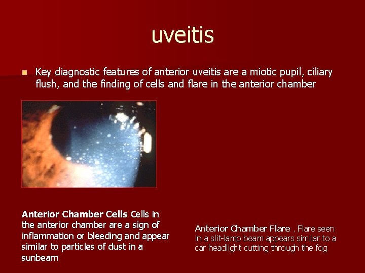 uveitis n Key diagnostic features of anterior uveitis are a miotic pupil, ciliary flush, uveitis n Key diagnostic features of anterior uveitis are a miotic pupil, ciliary flush,