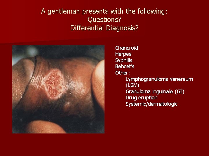 A gentleman presents with the following: Questions? Differential Diagnosis? Chancroid Herpes Syphilis Behcet’s Other: A gentleman presents with the following: Questions? Differential Diagnosis? Chancroid Herpes Syphilis Behcet’s Other: