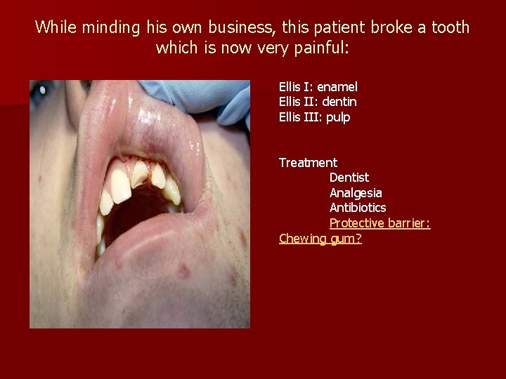 While minding his own business, this patient broke a tooth which is now very While minding his own business, this patient broke a tooth which is now very
