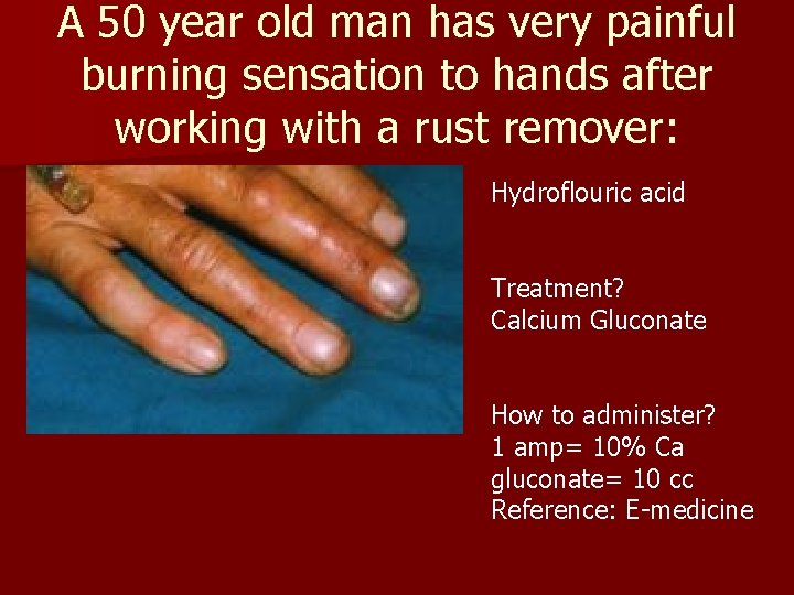 A 50 year old man has very painful burning sensation to hands after working A 50 year old man has very painful burning sensation to hands after working