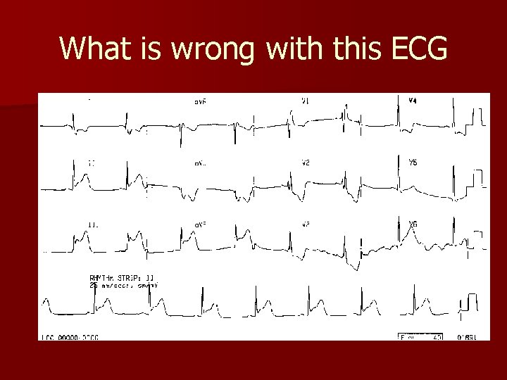 What is wrong with this ECG What is wrong with this ECG
