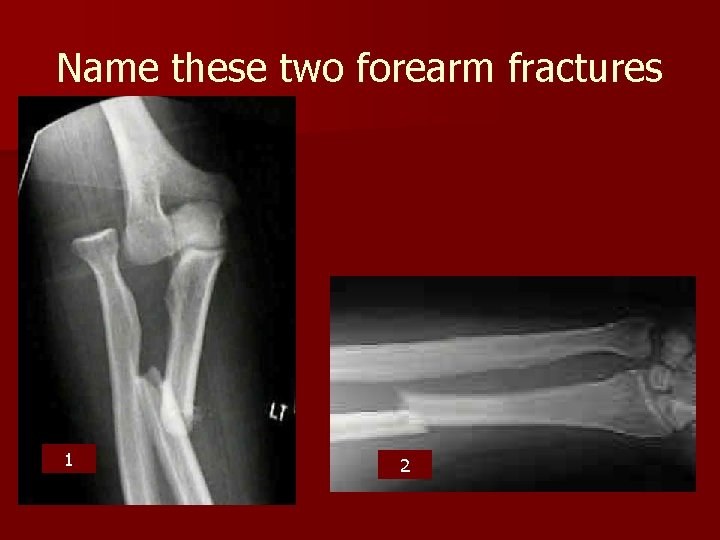 Name these two forearm fractures 1 2 Name these two forearm fractures 1 2