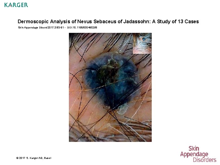 Dermoscopic Analysis of Nevus Sebaceus of Jadassohn: A Study of 13 Cases Skin Appendage