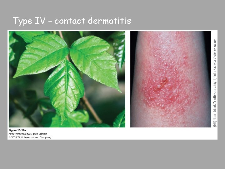 Type IV – contact dermatitis 