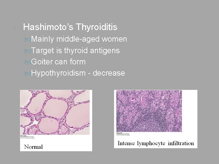  Hashimoto’s Thyroiditis Mainly middle-aged women Target is thyroid antigens Goiter can form Hypothyroidism