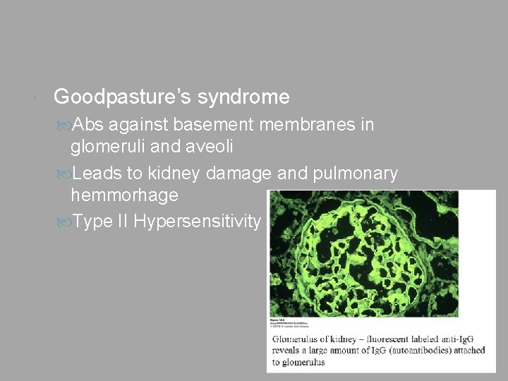  Goodpasture’s syndrome Abs against basement membranes in glomeruli and aveoli Leads to kidney