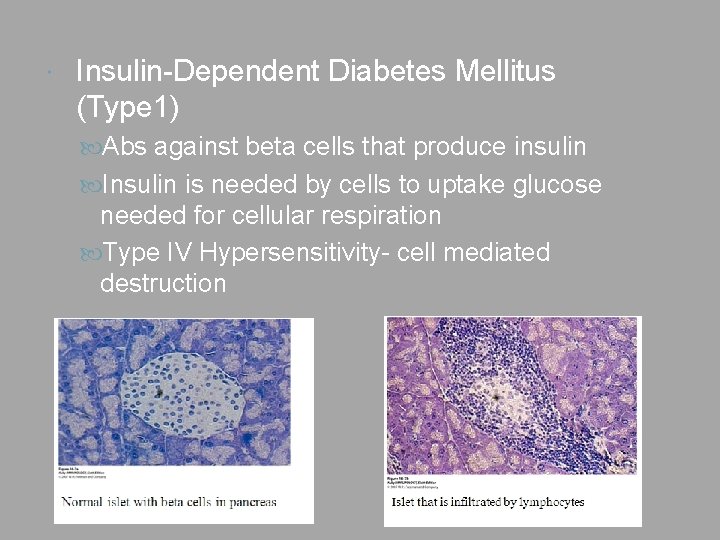  Insulin-Dependent Diabetes Mellitus (Type 1) Abs against beta cells that produce insulin Insulin