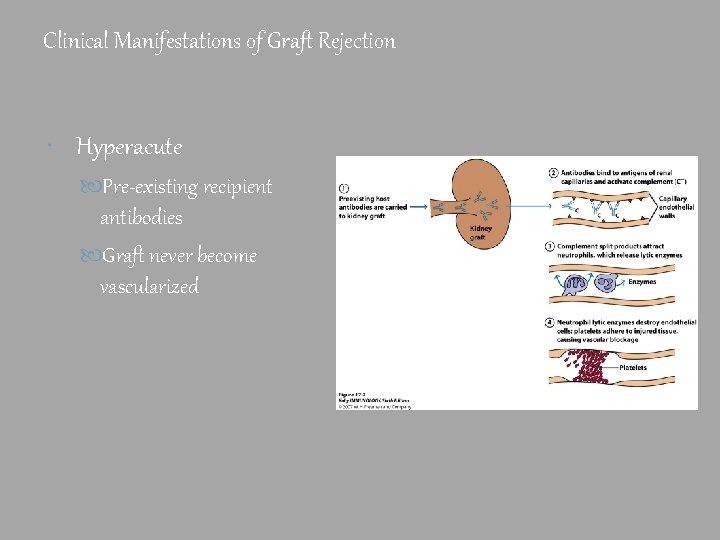 Clinical Manifestations of Graft Rejection Hyperacute Pre-existing recipient antibodies Graft never become vascularized 