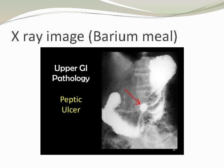 X ray image (Barium meal) 