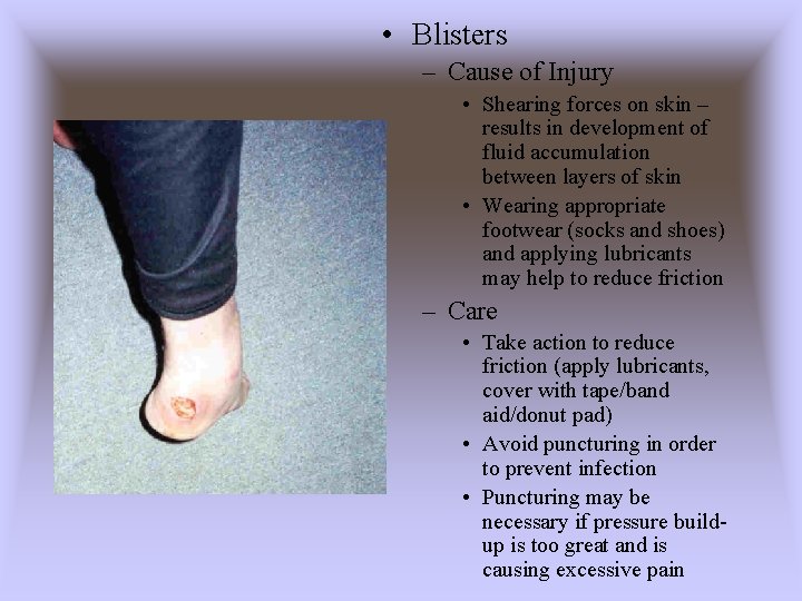  • Blisters – Cause of Injury • Shearing forces on skin – results