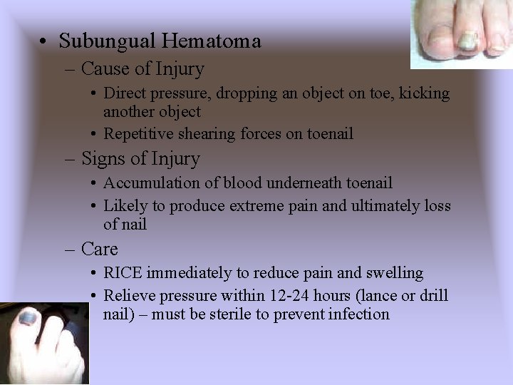  • Subungual Hematoma – Cause of Injury • Direct pressure, dropping an object