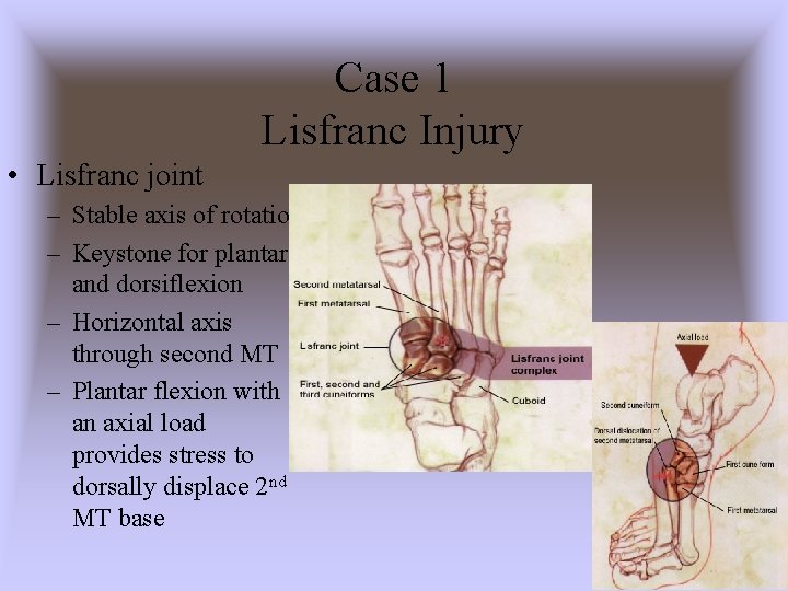 Case 1 Lisfranc Injury • Lisfranc joint – Stable axis of rotation – Keystone