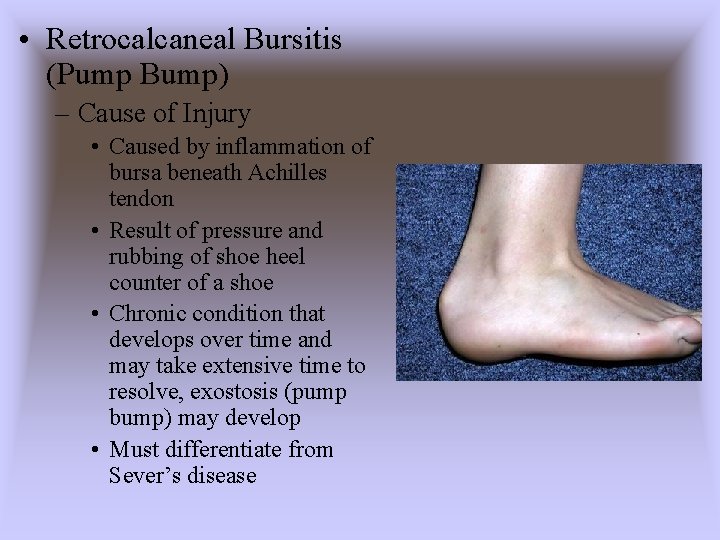  • Retrocalcaneal Bursitis (Pump Bump) – Cause of Injury • Caused by inflammation