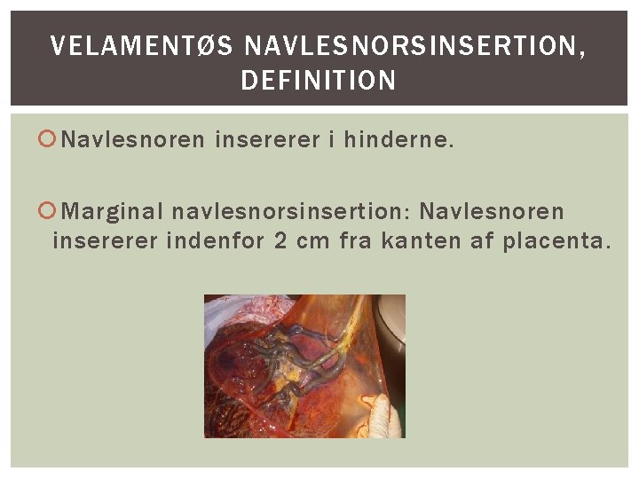 VELAMENTØS NAVLESNORSINSERTION, DEFINITION Navlesnoren insererer i hinderne. Marginal navlesnorsinsertion: Navlesnoren insererer indenfor 2 cm