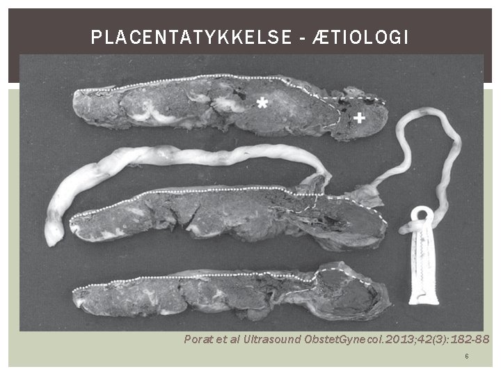 PLACENTATYKKELSE - ÆTIOLOGI Inflammation, ødem eller kompensatorisk hypertrofi Teori: hyperinflateret med maternelt blod pga