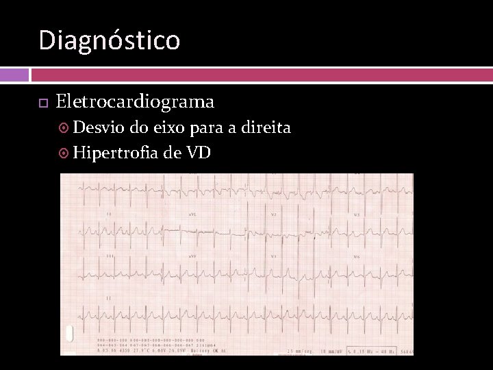 Diagnóstico Eletrocardiograma Desvio do eixo para a direita Hipertrofia de VD 