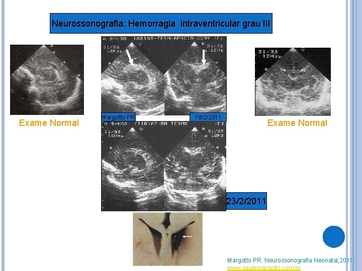 Neurossonografia: Hemorragia intraventricular grau III Exame Normal Margotto PR 18/2/2011 Exame Normal 23/2/2011 Margotto Neurossonografia: Hemorragia intraventricular grau III Exame Normal Margotto PR 18/2/2011 Exame Normal 23/2/2011 Margotto
