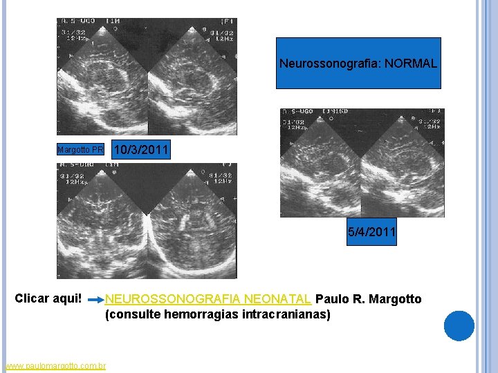 Neurossonografia: NORMAL 10/3/2011 Margotto PR 5/4/2011 Clicar aqui! NEUROSSONOGRAFIA NEONATAL Paulo R. Margotto (consulte Neurossonografia: NORMAL 10/3/2011 Margotto PR 5/4/2011 Clicar aqui! NEUROSSONOGRAFIA NEONATAL Paulo R. Margotto (consulte