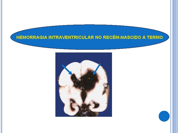 HEMORRAGIA INTRAVENTRICULAR NO RECÉM-NASCIDO A TERMO HEMORRAGIA INTRAVENTRICULAR NO RECÉM-NASCIDO A TERMO
