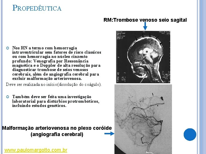 PROPEDÊUTICA RM: Trombose venoso seio sagital Nos RN a termo com hemorragia intraventricular sem PROPEDÊUTICA RM: Trombose venoso seio sagital Nos RN a termo com hemorragia intraventricular sem