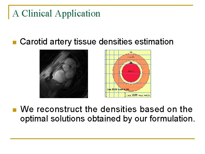 A Clinical Application n Carotid artery tissue densities estimation n We reconstruct the densities