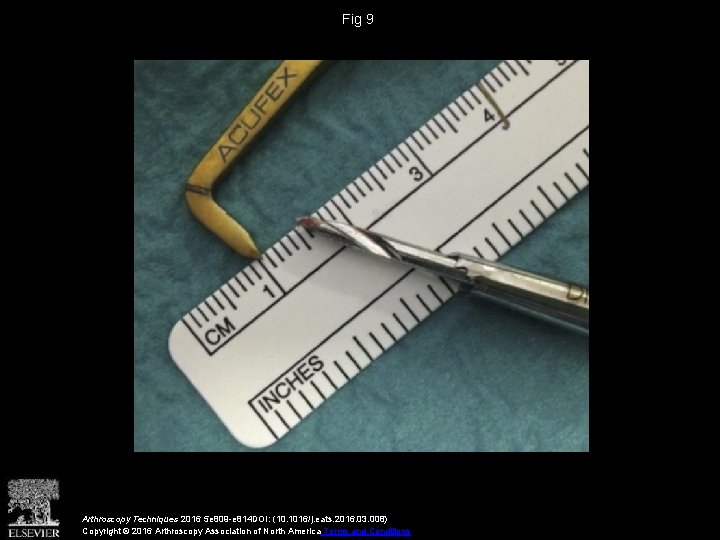 Fig 9 Arthroscopy Techniques 2016 5 e 809 -e 814 DOI: (10. 1016/j. eats.