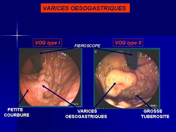 VARICES OESOGASTRIQUES VOG type I PETITE COURBURE FIBROSCOPE VARICES OESOGASTRIQUES VOG type II GROSSE