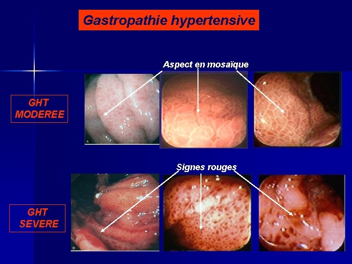 Gastropathie hypertensive Aspect en mosaïque GHT MODEREE Signes rouges GHT SEVERE 