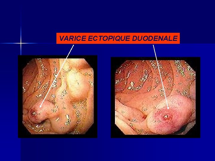 VARICE ECTOPIQUE DUODENALE 