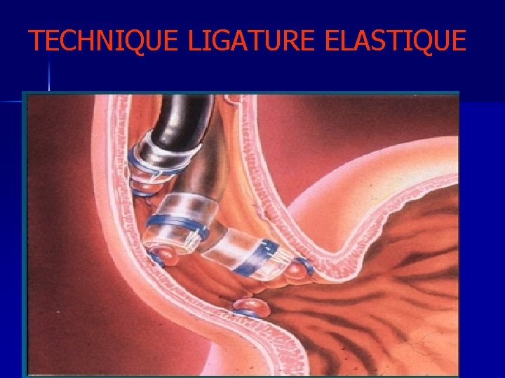 TECHNIQUE LIGATURE ELASTIQUE 