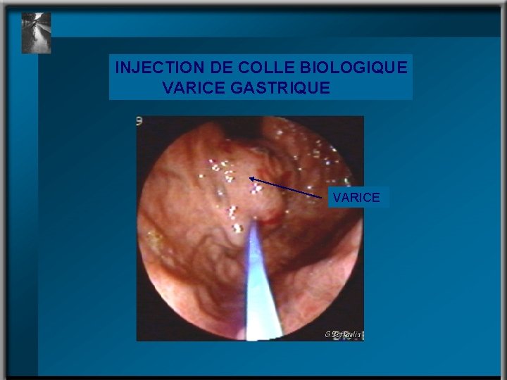 INJECTION DE COLLE BIOLOGIQUE VARICE GASTRIQUE VARICE 