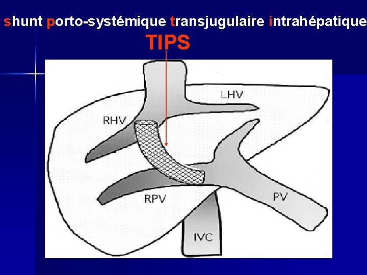 shunt porto-systémique transjugulaire intrahépatique TIPS 