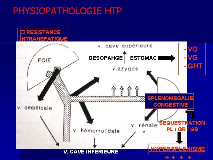 PHYSIOPATHOLOGIE HTP RESISTANCE INTRAHEPATIQUE OESOPAHGE ESTOMAC - VO - VG - GHT SPLENOMEGALIE CONGESTIVE