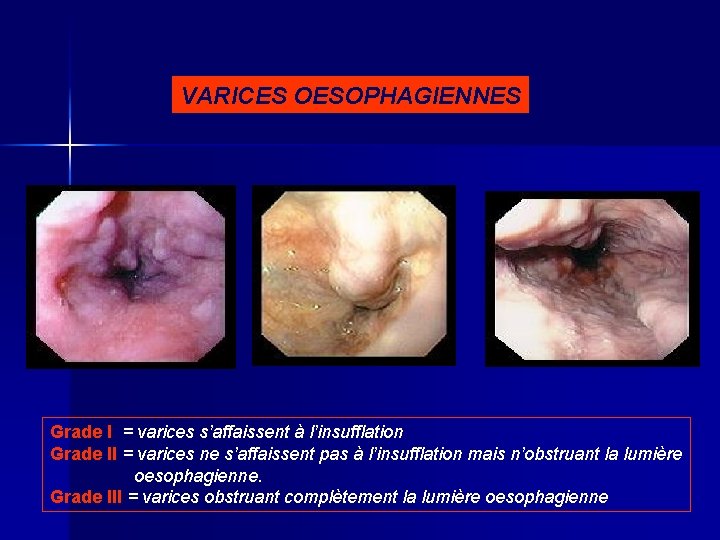 VARICES OESOPHAGIENNES Grade I = varices s’affaissent à l’insufflation Grade II = varices ne