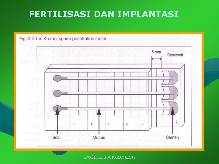 FERTILISASI DAN IMPLANTASI KMA, HIGERI SURABAYA, 2011 