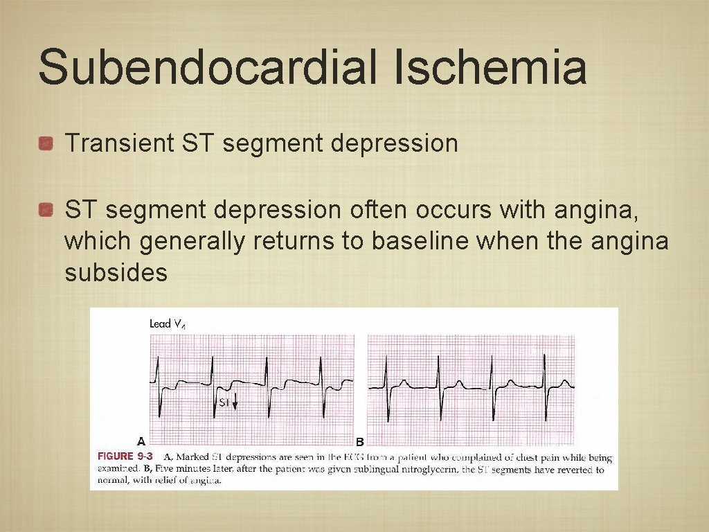 Myocardial Ishcemia and Infarction Chapter 8 St Segment