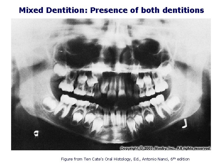 Mixed Dentition: Presence of both dentitions Figure from Ten Cate’s Oral Histology, Ed. ,