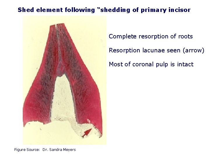 Shed element following “shedding of primary incisor Complete resorption of roots Resorption lacunae seen