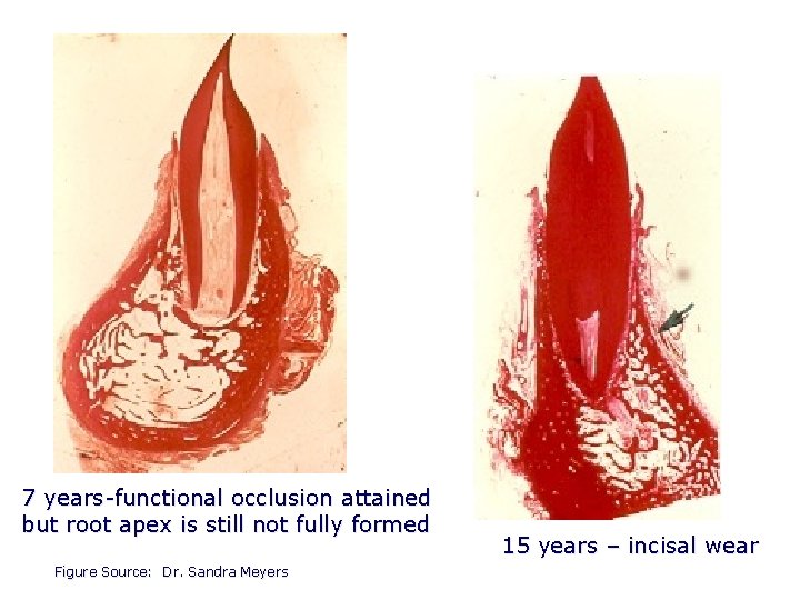 7 years-functional occlusion attained but root apex is still not fully formed Figure Source: