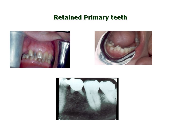 Retained Primary teeth 