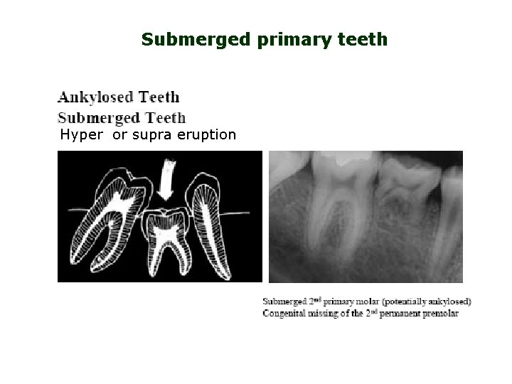 Submerged primary teeth Hyper or supra eruption 