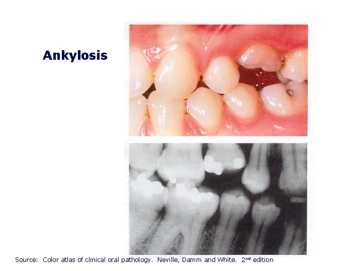 Ankylosis Source: Color atlas of clinical oral pathology. Neville, Damm and White. 2 nd