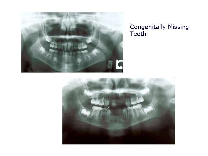 Congenitally Missing Teeth 